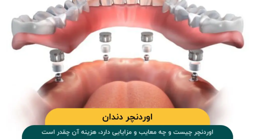 اوردنچر-دندان